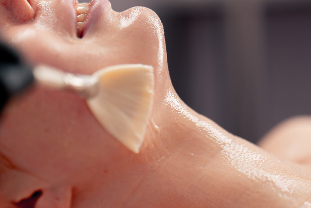 Chemical Peel